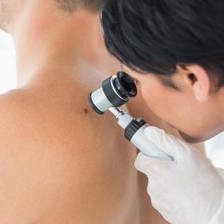 10 činjenica o melanomu: Ne razvije se uvijek iz madeža