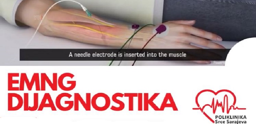 Elektromiografija Poliklinika Srce Sarajeva